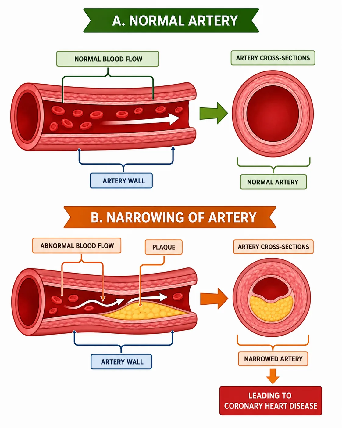 Normal artery vs narrowing of artery (plaque)