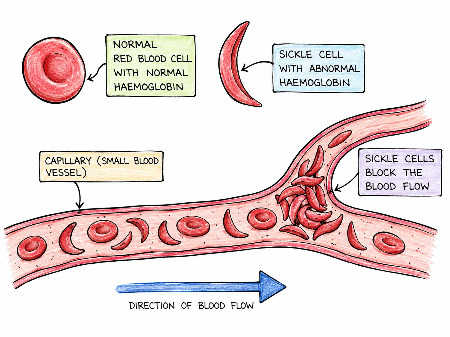 Sickle Cell Blood-Flow Blockage