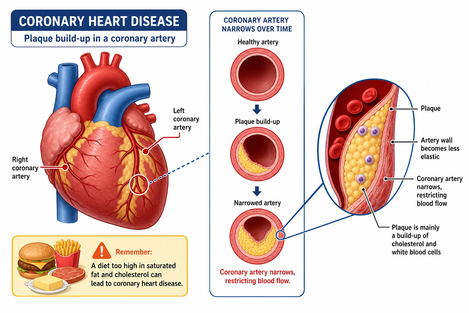 Coronary artery narrowing and coronary heart disease